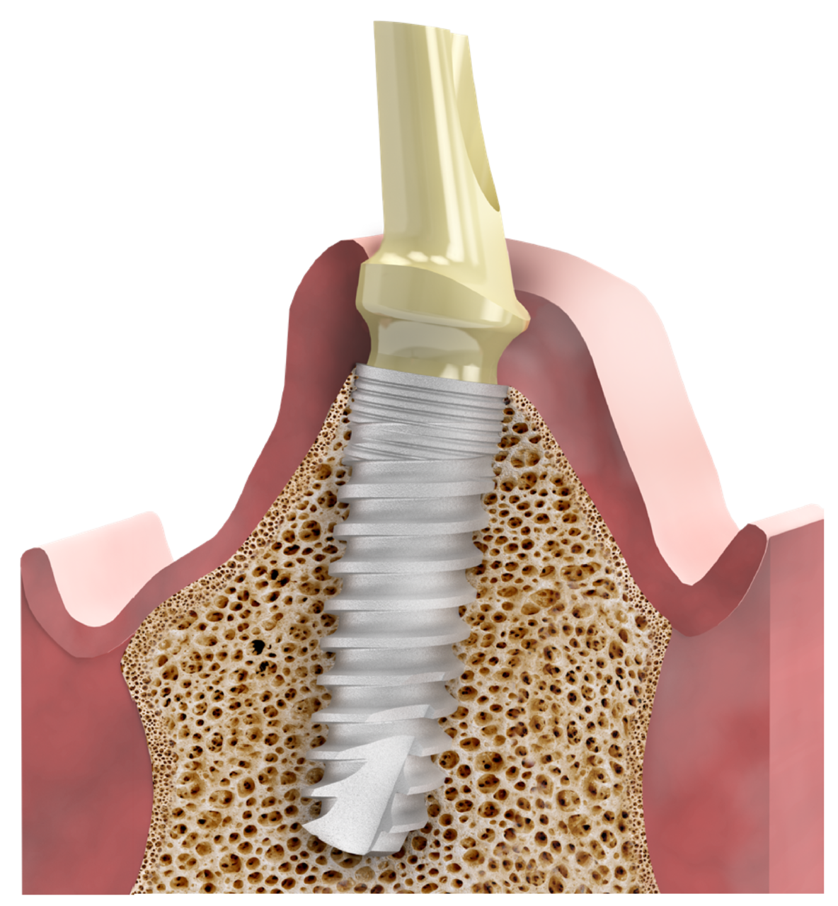 MIS-seven-implant4-2